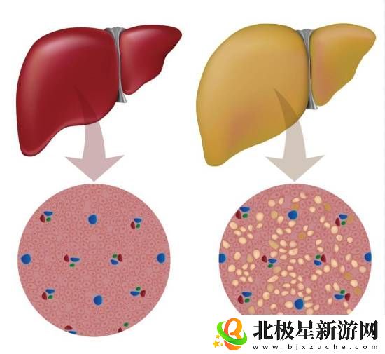 大学生月瘦20斤却患上脂肪肝